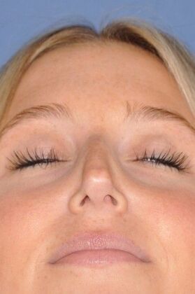 Rhinoplasty: Beautiful result in bump, crooked and blocked breathing - Before