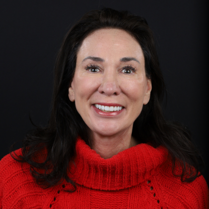 No Prep Porcelain Veneers Tricia - After