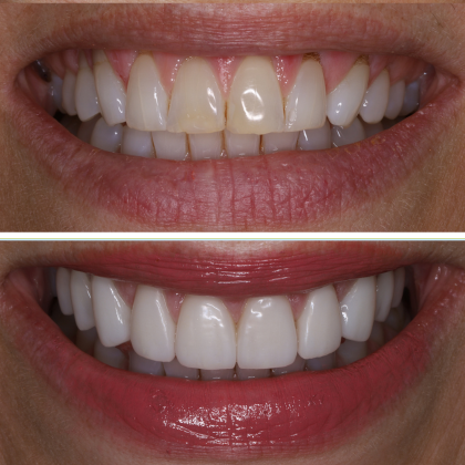 Minimal Prep Porcelain Veneers Cynthia - Before