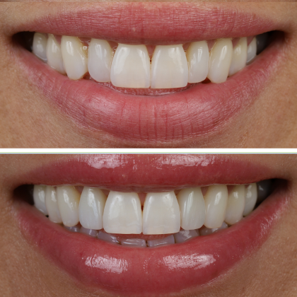 Minimal Prep Porcelain Veneers Jamie - Before