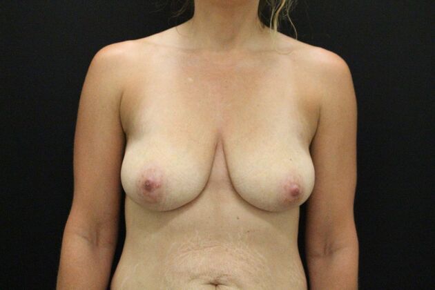 Breast Reduction & Lift Case 39 - Before