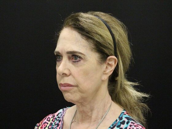 Face & Neck Lifts: Case 59 - Before