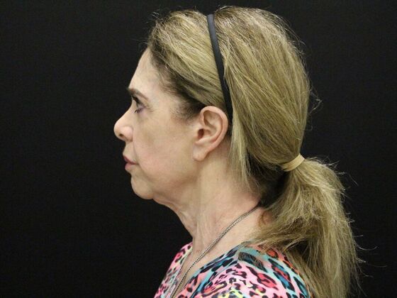 Face & Neck Lifts: Case 59 - Before
