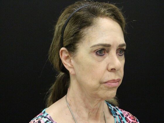 Face & Neck Lifts: Case 59 - Before