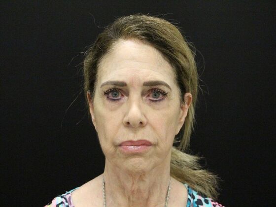 Face & Neck Lifts: Case 59 - Before