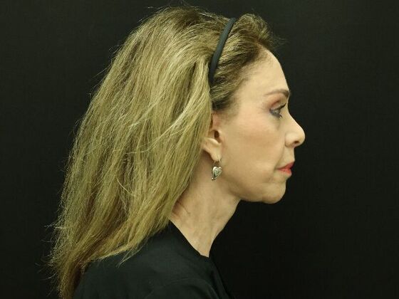 Face & Neck Lifts: Case 59 - After