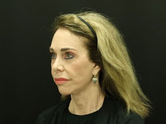 Face & Neck Lifts: Case 59 - After