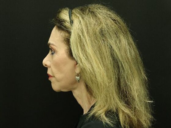 Face & Neck Lifts: Case 59 - After