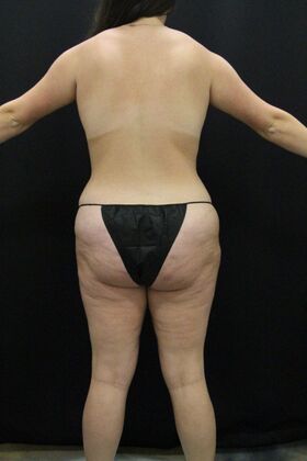 Tummy Tuck Case 85 - Before