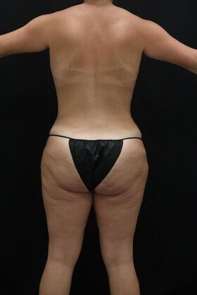 Tummy Tuck Case 85 - After