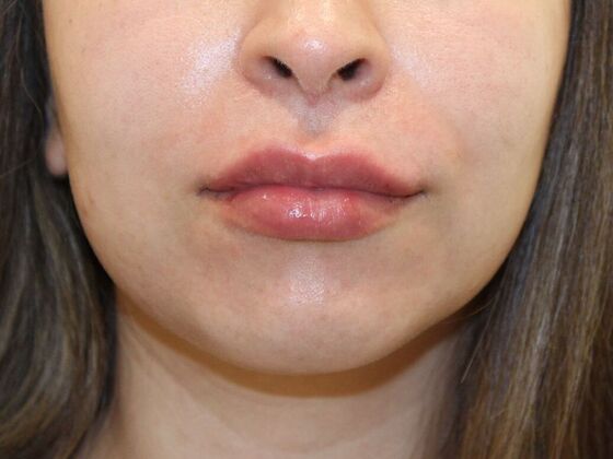 Injectables Case 100 - After