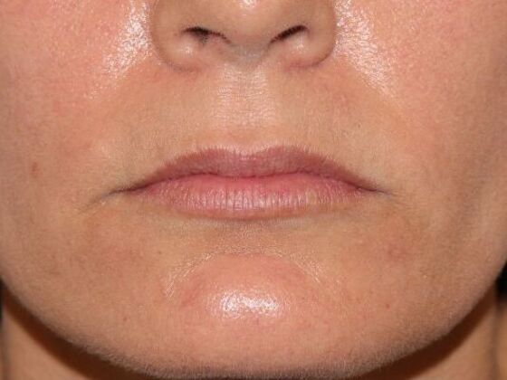 Injectables Case 101 - Before