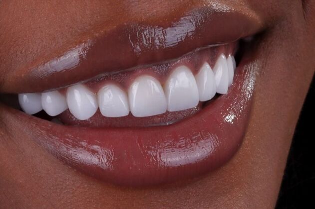 Smile Makeover & Veneers: Qway - After