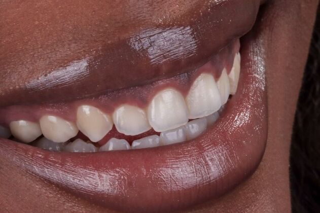 Smile Makeover & Veneers: Qway - Before