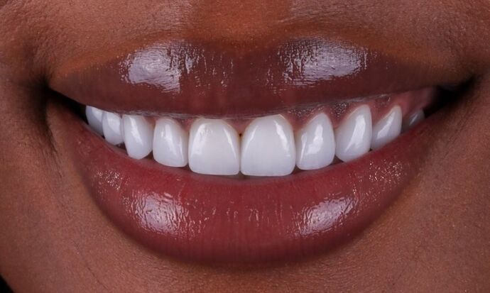 Smile Makeover & Veneers: Qway - After