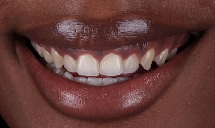Smile Makeover & Veneers: Qway - Before
