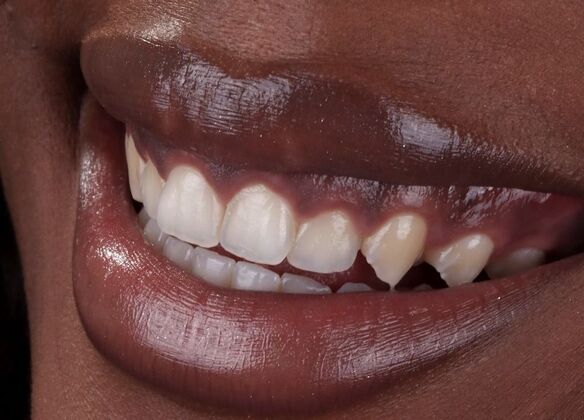 Smile Makeover & Veneers: Qway - Before