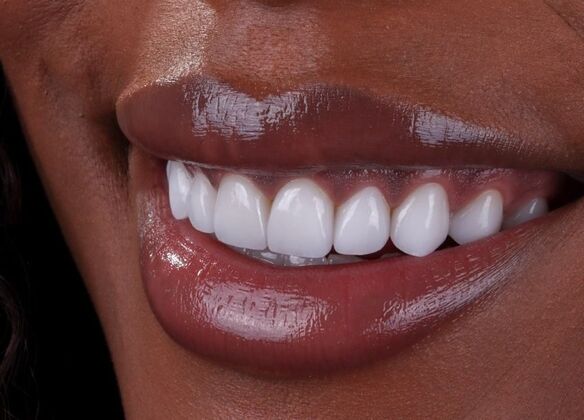 Smile Makeover & Veneers: Qway - After