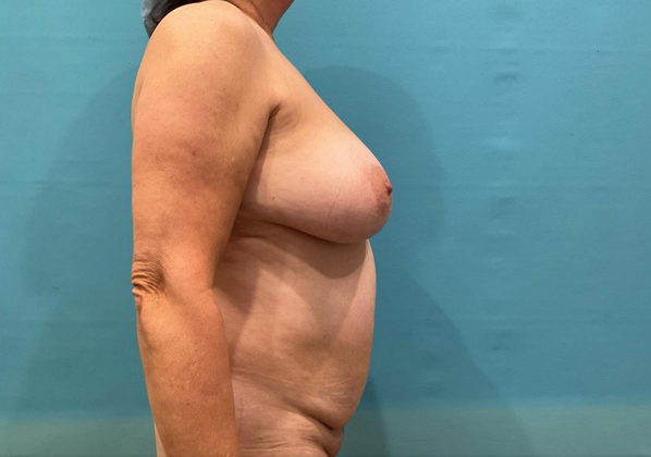 Mommy Makeover: Case 41 - Before