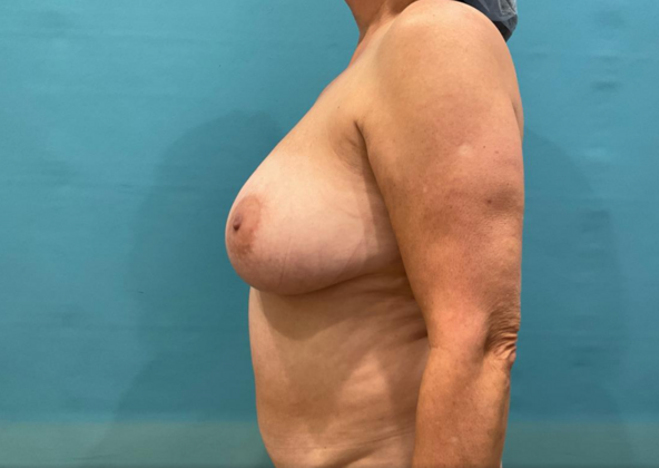 Mommy Makeover: Case 41 - Before