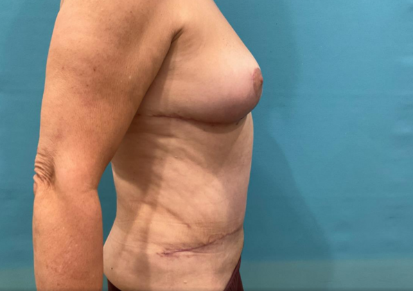 Mommy Makeover: Case 41 - After