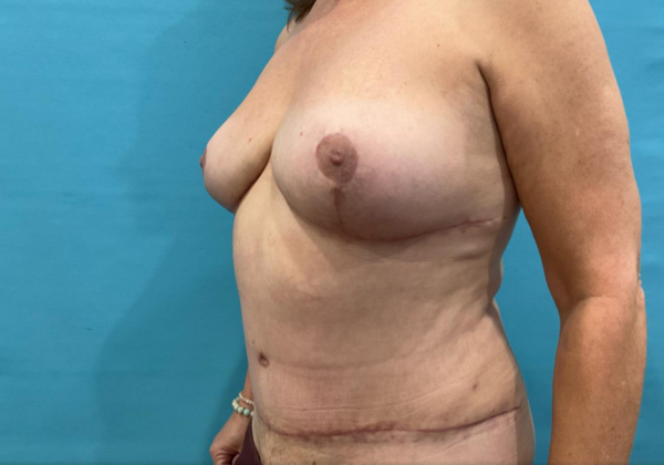 Mommy Makeover: Case 41 - After