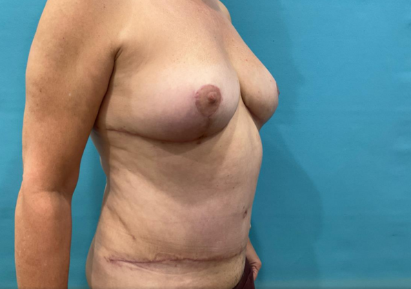 Mommy Makeover: Case 41 - After