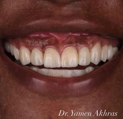 Full Mouth Reconstruction Cases by Dr. Yamen Akhras Case 3 - After