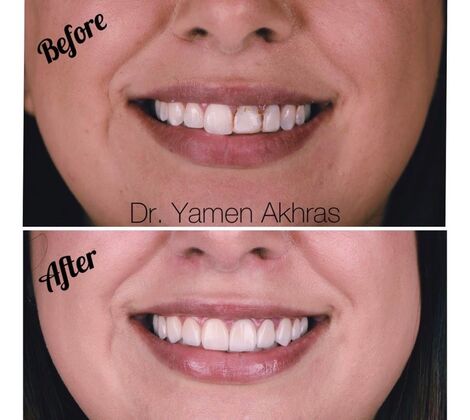 Periodontics Cases by Dr. Yamen Akhras Case 5 - Before