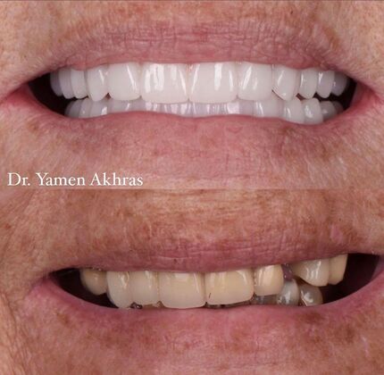 Full Mouth Reconstruction Cases by Dr. Yamen Akhras Case 4