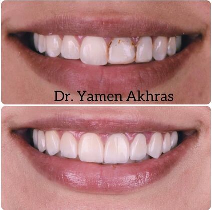Periodontics Case 1 - After