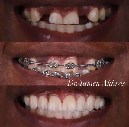 Full Mouth Reconstruction Case 1 - Before