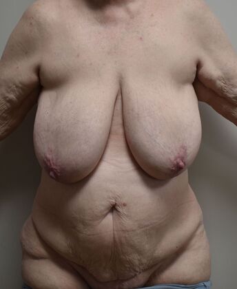 Massive Weight Loss : Case 199 - Before