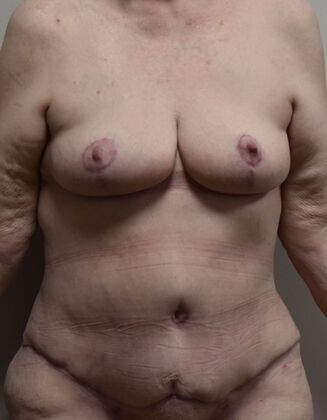 Massive Weight Loss : Case 199 - After