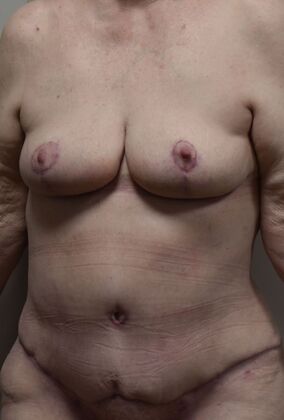 Massive Weight Loss : Case 199 - After