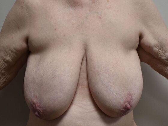 Breast Reduction: Case 207 - Before