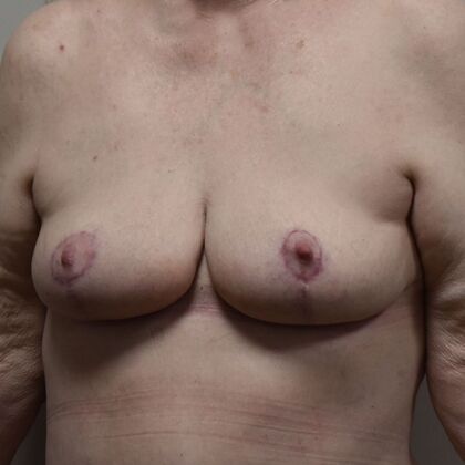 Breast Reduction: Case 207 - After