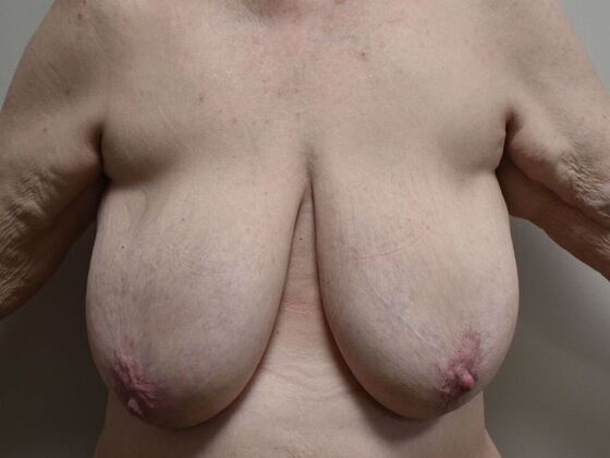 Breast Lift (Mastopexy) Case 258 - Before