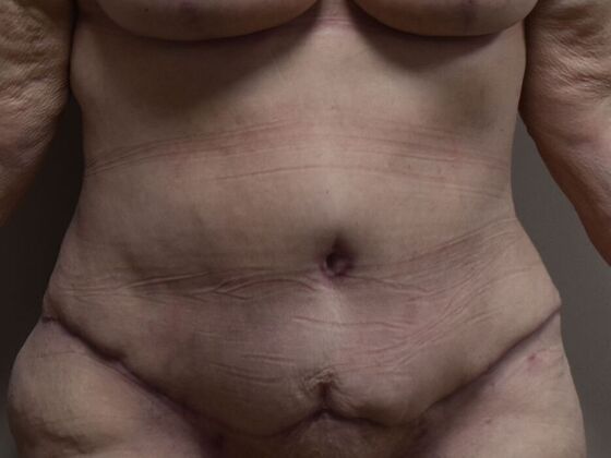 Tummy Tuck (Abdominoplasty): Case 572 - After
