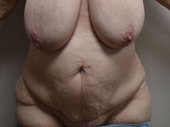 Tummy Tuck (Abdominoplasty): Case 572 - Before