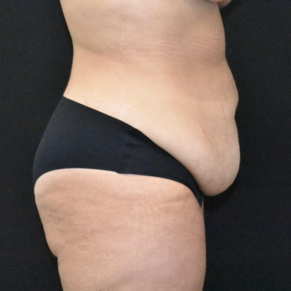 Abdominoplasty: Case 37 - Before