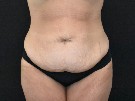 Abdominoplasty: Case 37 - Before