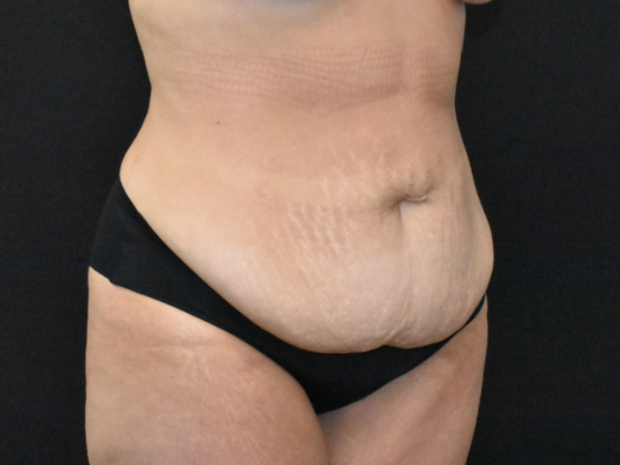 Abdominoplasty: Case 37 - Before
