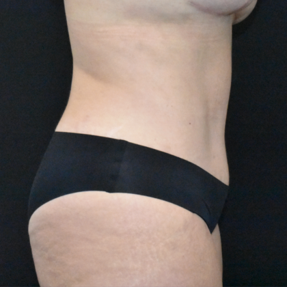 Abdominoplasty: Case 37 - After