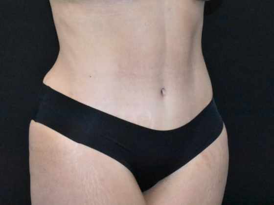 Abdominoplasty: Case 37 - After