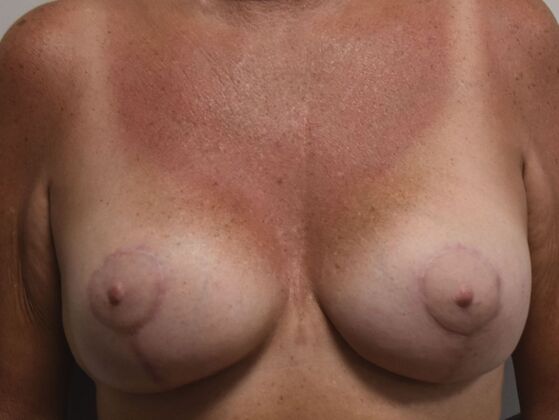 Breast Augmentation w/ Lift: Case 636 - After