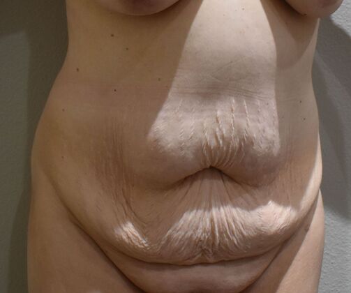 Tummy Tuck (Abdominoplasty): Case 573 - Before