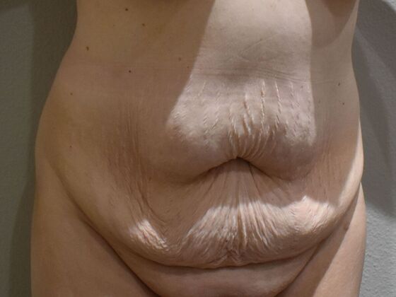 Tummy Tuck (Abdominoplasty): Case 23 - Before