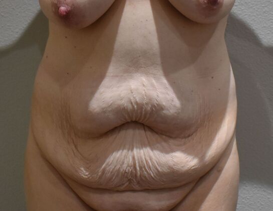 Massive Weight Loss : Case 200 - Before