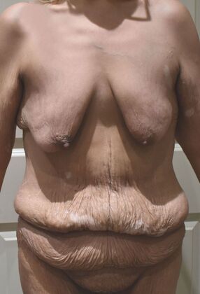 Massive Weight Loss : Case 201 - Before